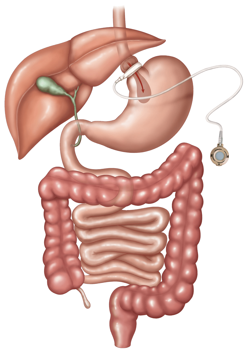 Cirurgia da banda gástrica