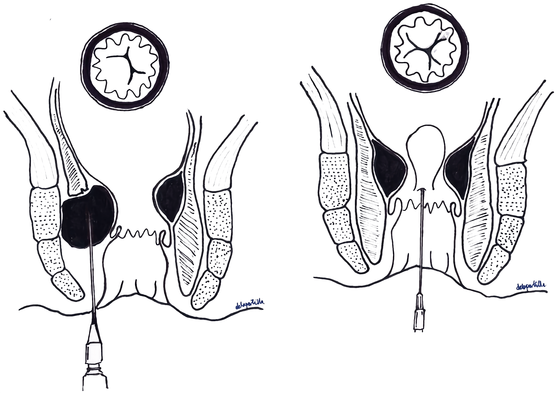 Técnicas de preenchimento